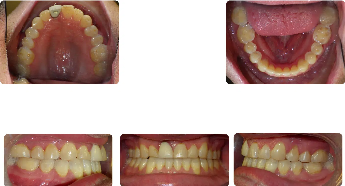 Case #4 After Case #4 After