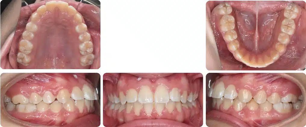 Case #5 After Case #5 After