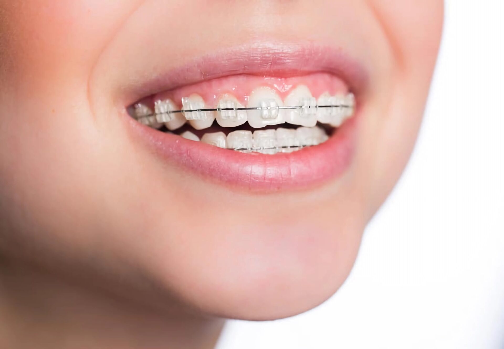 Ceramic braces Ceramic braces