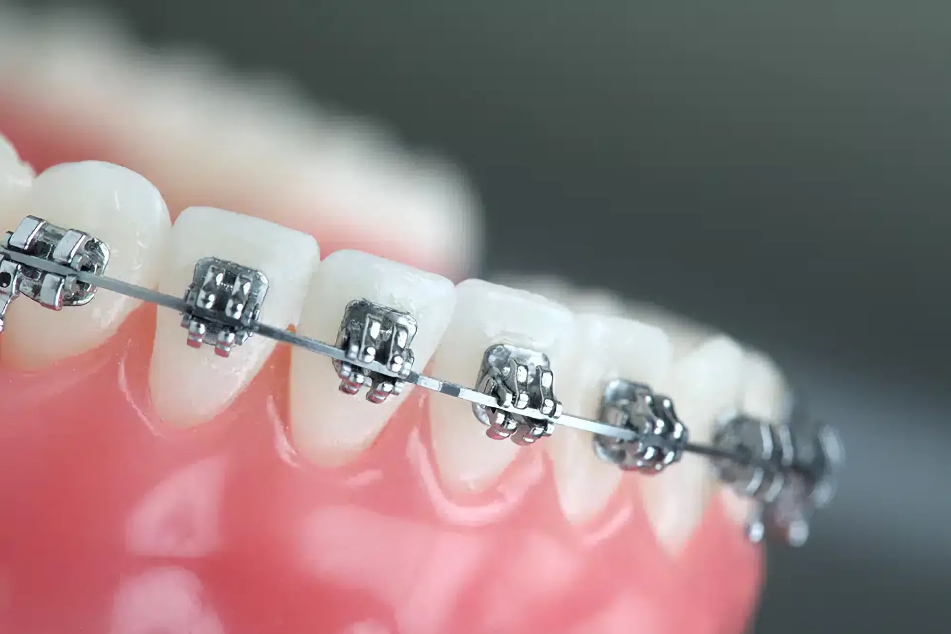 Traditional Braces Traditional Braces